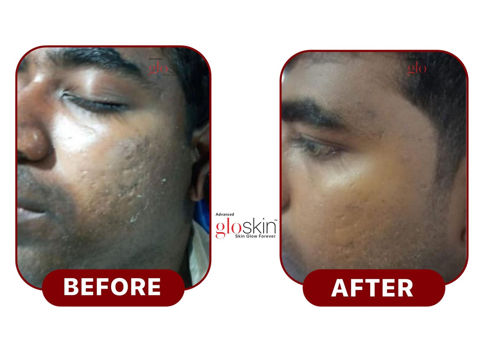 Microneedling